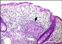 What is the arrow pointing to? What disease is this characteristic of? In what layer is this typically present? What other cells do you see?