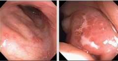 What do you see in this endoscopy? What could this?