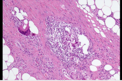 Fibrosis
What is this? 
 
Description:
Swollen venules
 Granulation tissue can be seen between adipose tissue lobules and the connective tissue septa.
 
What cells are involved?