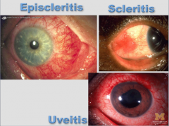 Infection of the sclera and conjunctiva => parallels activity of UC and Crohn's (6% of Crohn's). Involves deeper structures of eye => requires urgent care.