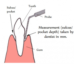 A groove or depression


 


Pocket depth used to measure for periodontal disease.