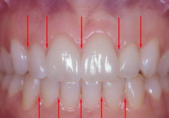 Triangular shaped crests of gingival tissue located between the teeth. The crests of tissue consists of free and attached gingiva.