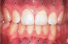 Located below the sulcus, this line seperates the free gingiva and the attached gingiva.