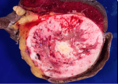 What type of tumor? Describe the gross appearance.