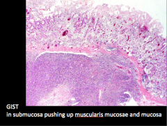 Submucosal spread of the tumor in the stomach.
All GISTs should consider to have some malignant potential.
The best predictor of biological behavior of GISTs is a combination of:
Tumor size
Mitotic activity
Necrosis