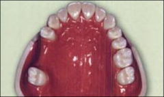 Clase III: presenta espacios desdentados laterales limitados a nivel mesial y a nivel distal por dientes, es decir se apoya totalmente sobre dientes.