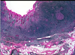 What type of neoplasm? What is it infiltrating and expanding into? 
What is the challenge for the pathologist?