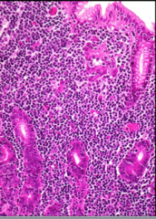 The feature visible on routine H&E stain most diagnostic of MALToma is lymphocytes surrounding, infiltrating, and overrunning gastric glands. What is this lesion called?