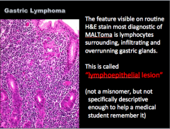 Many neoplastic cells also have plasmacytoid features (B-cell tumors)