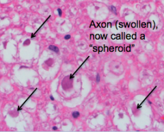 Axons swell up and become spheroids.