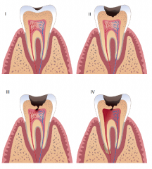 Smooth surface caries- triangular shaped decay that usually occurs between the teeth below the contact area.


 


On surface of enamal