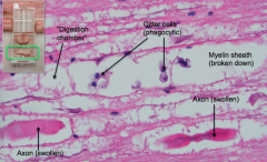 The myelin sheath will break down, you will see Gitter cells (phagocytic), and there will be digestion chambers