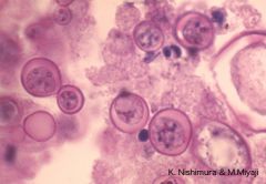 Blastomyces dermatitidis aka Chicago Disease, Gilchrist’s Disease