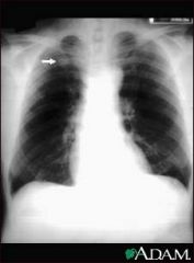 X-ray films: Sharply circumscribed pulmonary nodule – usually non-calcified, Patchy bronchopneumonia, Pleural effusion (hilar adenopathy is common)

Coccidioides Spherical Stains – Periodic Acid-Schiff (PAS); KOH + Calcofluor; Methenamine Silver Stain
