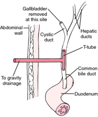 T-Tube drain is used for mostly for patients who have undergone gallbladder surgery or surgery of the surrounding tubes draining the gallbladder. This type of drainage most resembles a T and drains into a collection bag.

>The tube facilitates biliary d