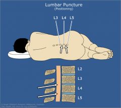 After Lumbar Puncture (Spinal Tap)

(and also oil-based Myelogram)