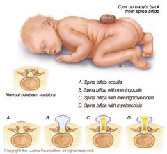 Infant w/ Spina Bifida