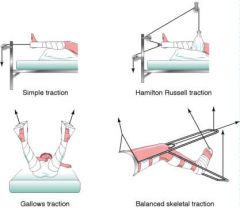 Buck's Traction (skin traction)