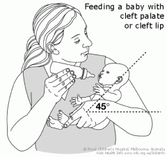 --> position on back or in infant seat to prevent trauma to suture line. While feeding, hold in upright position.