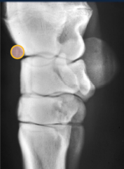 chip fracture
distolateral aspect of the radius