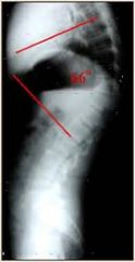 Thoracic hyperkyphosis (>40 degrees ) is a risk factor for pseudoarthrosis in patients treated with this method.moking, weight >70 kg, and T5-T12 hyperkyphosis of > 40.Ans5
