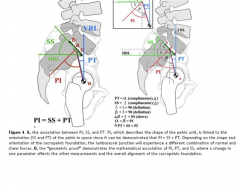 Pelvic Incidence (Ang X) = Pelvic Tilt (Ang Z) + Sacral Slope (Ang Y); (PI) correlates strongest w/ isthmic spondylolisthesis grd. PI is const childhd (~47 deg), const in adulthd (~57 deg). PI is not affected by changes in posture.Ans1