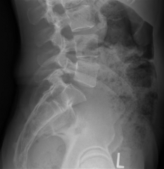 28yo F c/o LBP p/fell off a horse 2 D ago. She has no neurologic deficits. lat xray & axial CT scan Fig A & B,  What is 1st line of tx? 1-Obser, mobilization, & further tx based on sx, 2-Spinal casting & bed rest x 6 wks; 3-Thoracolumbosacral orth...