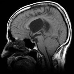 Chiari II malformation where the posterior fossa is too small, allowing the malformed cerebellum to compress the 4th ventricle.