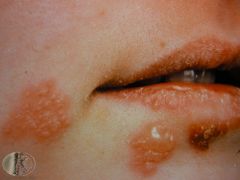A 2yr old presents with a high fever, restlessness and excessive dribbling. Whitish vesicles evolve to yellowish ulcers on the tongue, throat, palate, cheeks. What is this condition?