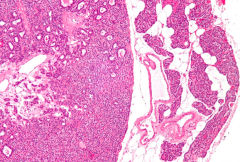Parathyroid Adenoma
- Composed of sheets of chief cells with decreased stromal fat
- Oxyphil cells may also be present
- Rim of normal parathyroid at periphery (with interspersed fat)