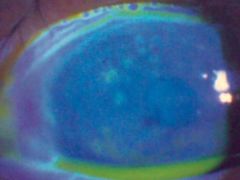 Dot-like ulcers seen on the surface of the cornea during infections w/ herpes zoster.