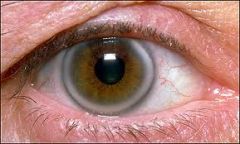 A gray-white band of lipid depositions that parallels the edge of the cornea at the limbus.