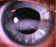 A manifestation of chronic hypercalcemia that is calcium deposits beneath the corneal epithelium and may extend across the pupil to obscure vision.