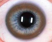 A golden-brown or green ring that occurs at the periphery of the cornea due to copper deposition in Descemet's membrane. 

***Characteristic of Wilson's dz.