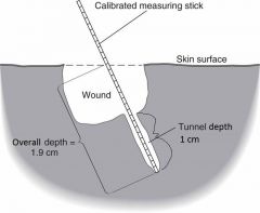 Wound tunnels 1.0 cm at 3-O'clock position, extending the depth to 1.9 cm