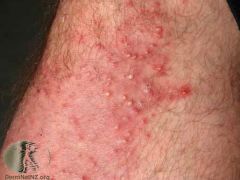 A patient living in the tropics presents with itchy pustules, in/around the hair of his leg. What is this condition? 
