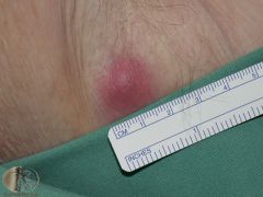  A patient presents with a deep tender and painful red nodule that is enlarging, fluctuant and has developed a necrotic centre. What is this condition? 