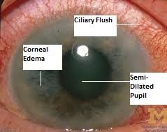 Causes congestion of the deep conjunctival and episcleral blood vessels, so the conjunctiva produces a red eye w/ a ciliary flush around the corneal limbus.