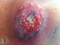 What is this lesion called?