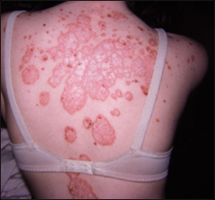 Psoriasis - what is occurring with this disorder & What is the treatment of this condition?