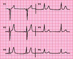 What is the cause of the wide QRS complex