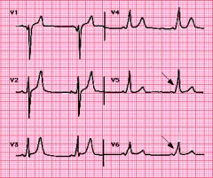 Wolff-Parkinson-White pattern
Precordial leads in a patient with preexcitation due to the WPW syndrome. The three characteristic findings are the short PR interval (0.09 sec in this case), the wide QRS, and the delta wave (slurring of the QRS ups...