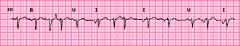 Multifocal atrial tachycardia
* Electrocardiogram showing multifocal atrial tachycardia in a woman with severe pulmonary disease. The diagnostic criteria include an average atrial rate above 100 beats/min and at least three different consecutive ...