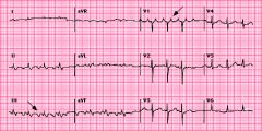 Atrial flutter with 2:1 block
Typical atrial flutter with 2:1 atrioventricular block. The flutter rate is approximately 300/min with a ventricular rate of 150/min. The flutter waves are best seen in leads II, III, and V1 (arrows). This patient al...