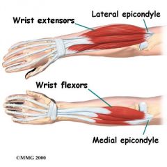 The painful inflammation of tendons surrounding an epicondyle.

-Tennis elbow: Lateral epicondylitis
-Golfer's elbow: Medial epicondylitis