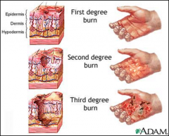 Identify the description of all the burn depths, superficial---deep full-thickness
