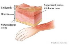 PARTIAL-THICKNESS BURNS (2nd Degree)
