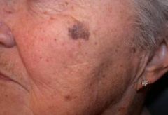 AKA cutaneous or or malignant melanoma. Arises from melanocytes the cells that produce melanin. Incidence is increasing annually doubleld in past 3 yrs. Can metastasize when penetrate dermis and mingle with blood/lymph vessels. Precursor lesions a...