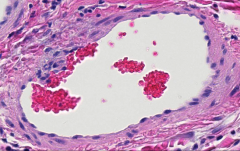 elongated and oriented in the direction of the cytoplasm
in blood vessels, the endothelial cells will orient longitudinally in the direction of the blood flow. a cross section of a vessel will also show a cross sectional cut of the nucleus (it wi...