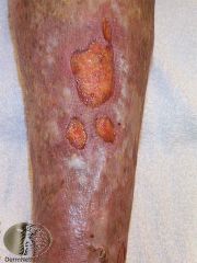 A patient with varicose veins, develops a painless ulcer, associated with leg swelling, surrounded by mottled brown staining and dry, itchy, reddened skin. What type of ulcer is this?